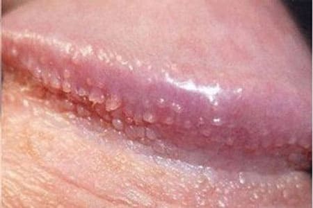Sùi mào gà là gì? Nguyên nhân và Cách trị