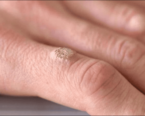 Mục cóc: Nguyên nhân, triệu chứng và cách trị