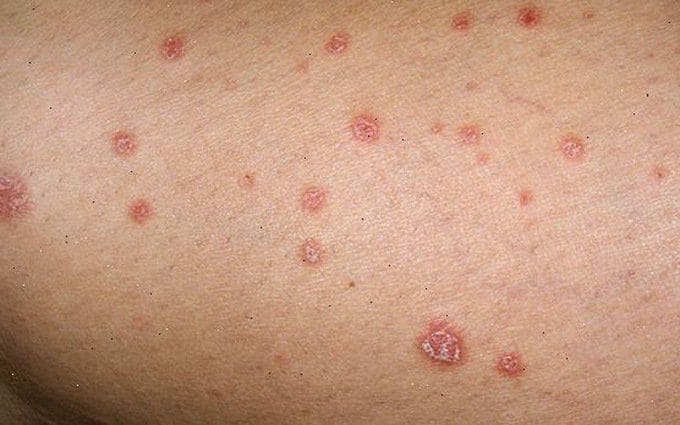 Bệnh lậu là gì? Nguyên nhân và Cách trị